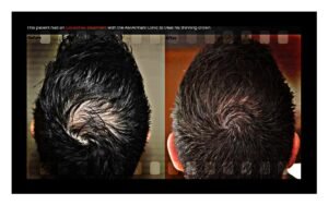 The 7 Core Pillars of Hair Loss Treatment in 2026